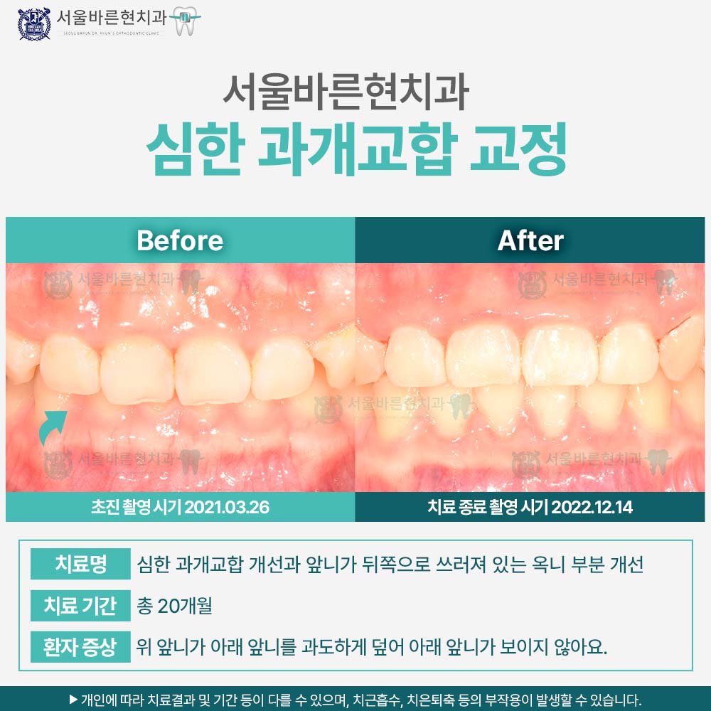 부산치아교정