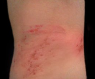 아토피 가려움증