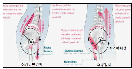골반 안정화 이미지