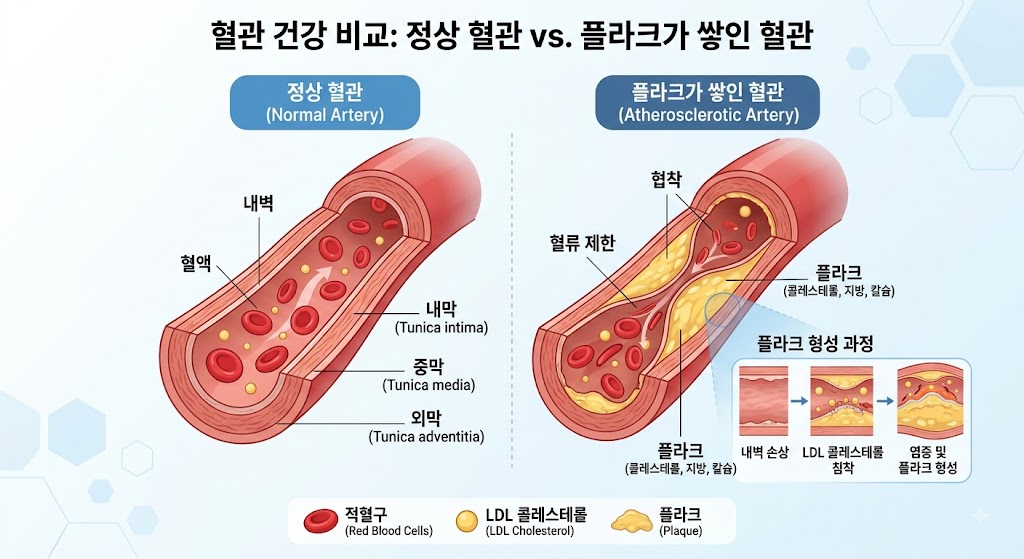 혈관 내벽에 플라크가 쌓이는 기전과 정상 혈관을 비교