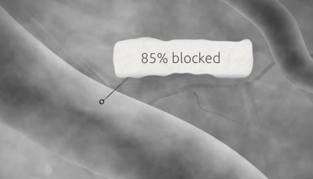 관상동맥 조영술