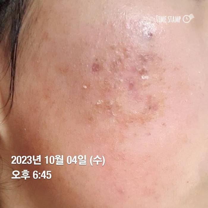 얼굴 피부염