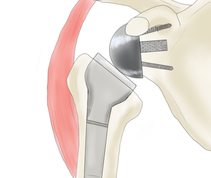 어깨 인공관절 수술