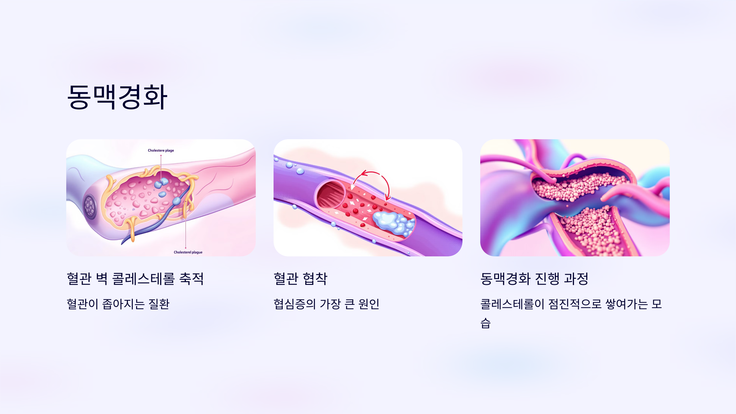 협심증과 관련된 사진입니다.