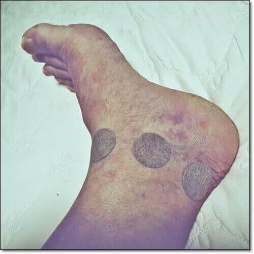 발목 접질렀을때 증상