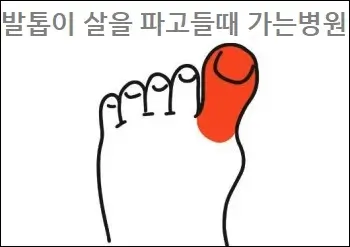 발톱이 살을 파고들때 가는병원