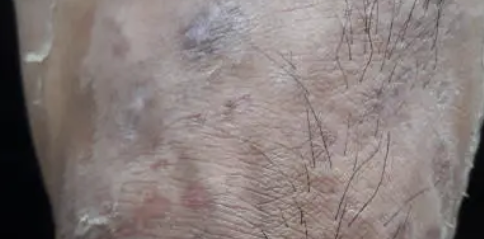 하지 정맥류 증상 35