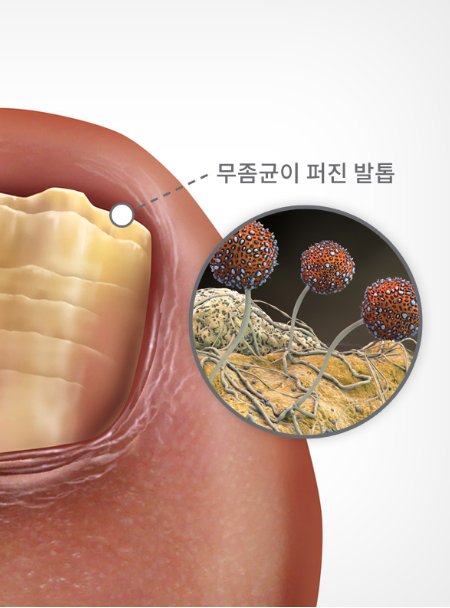 무좀 증상별 무좀약 추천