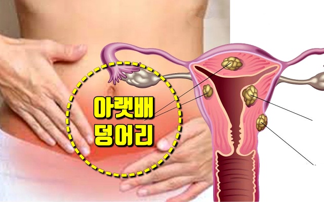 자궁 혹,자궁근종 증상 6,아랫배 덩어리,팁줌