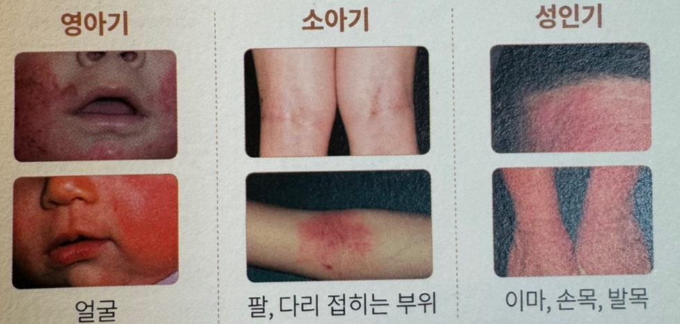 나이에 따른 발생 부위