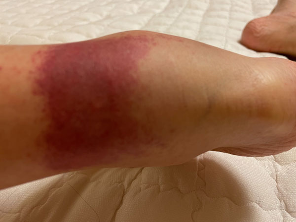 혈관염 증상이 악화되어 출혈이 덩어리로 커짐