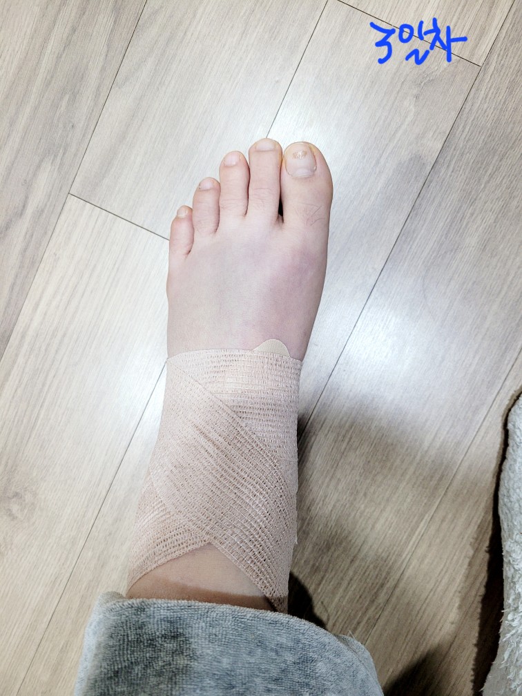 발목-접질렀을-때