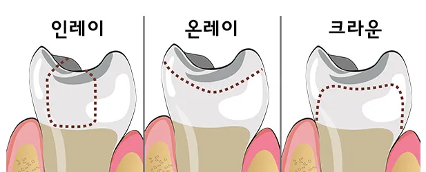 인레이 온레이의 차이와 치료 방법_4