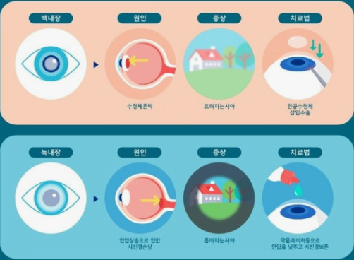백내장과 녹내짐 수술 관련 사진