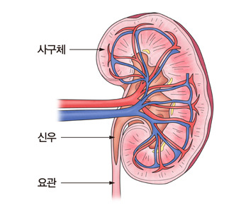 신장암 증상
