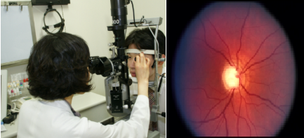 녹내장 관련 이미지