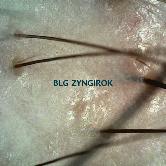 탈모 극복 프로젝트 - 오른쪽 M자 부위 두피모습이다.