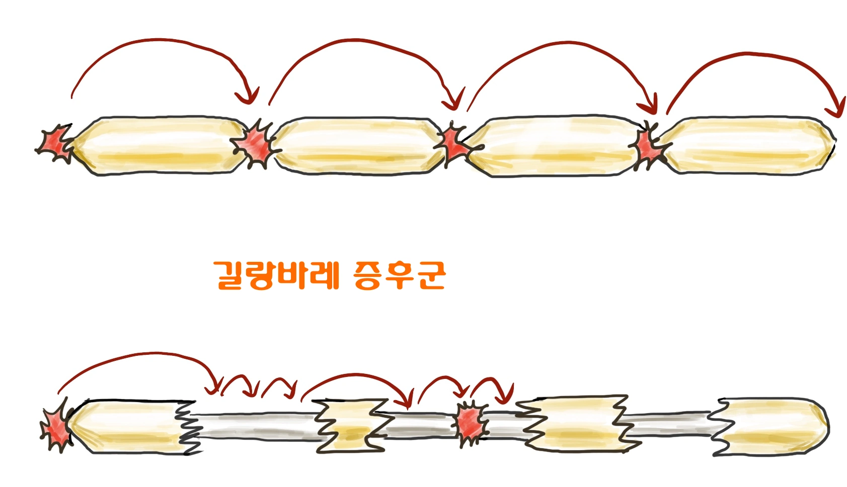 길랑바레 증후군 