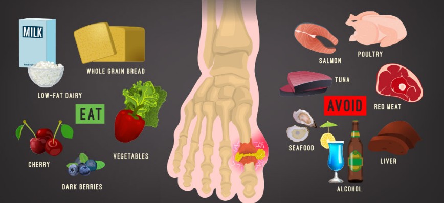 통풍 초기증상과 원인, 요산수치 낮추는법