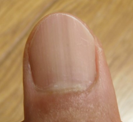 손톱에 세로줄이 생기는 이유