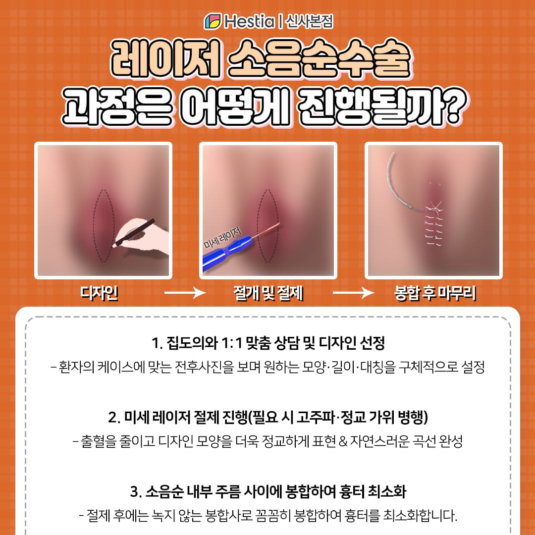 레이저 성형술 과정은 어떻게 진행될까?