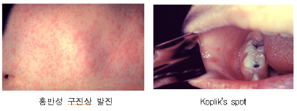 홍역 발진