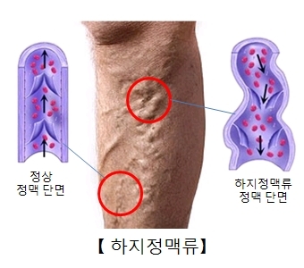 하지정맥류란