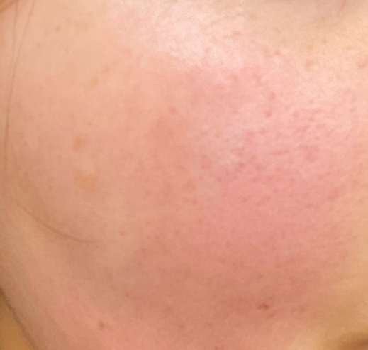 안면홍조증 치료연고