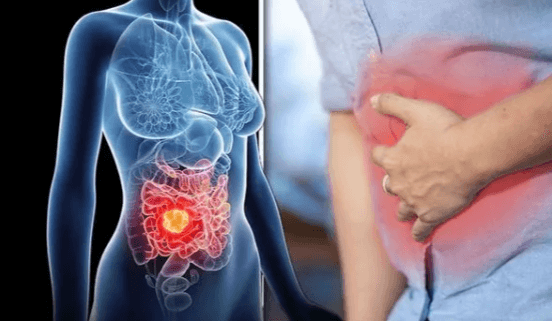 대장암 초기증상