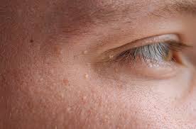 비립종 관련 사진