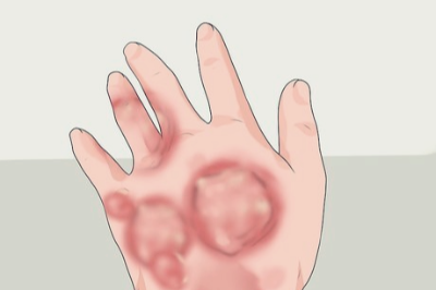 화상입었을때 대처법