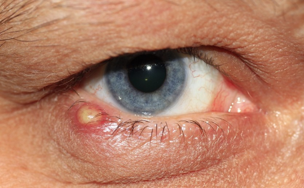눈꺼풀 염증 주요 증상과 원인 및 관리 방법 관련 사진