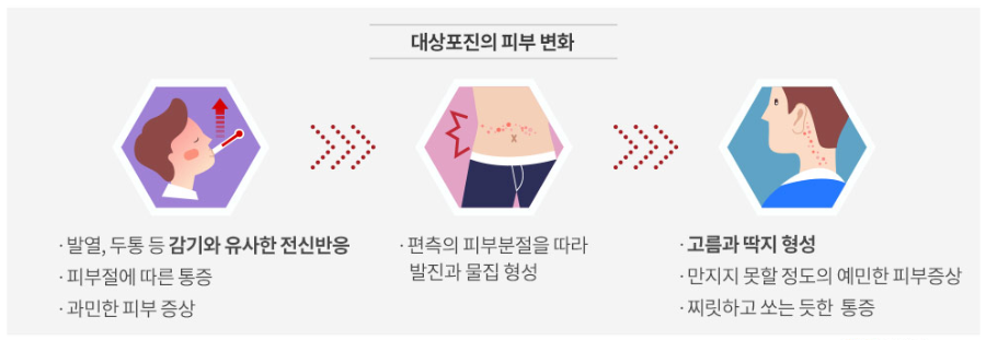 대상포진 변화 순서