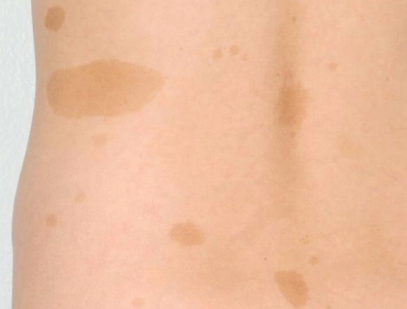 신경섬유종 밀크반점이란?