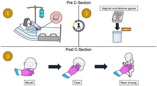 산도 미생물 이식
