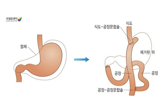 위전절제술후 소화기계 구조 이미지