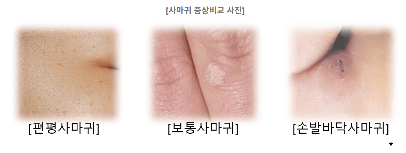 편평사마귀 원인, 증상, 치료 및 주의사항