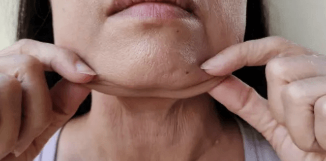 턱밑살 지방제거와 브이라인 피부과 시술 추천 탑5 !