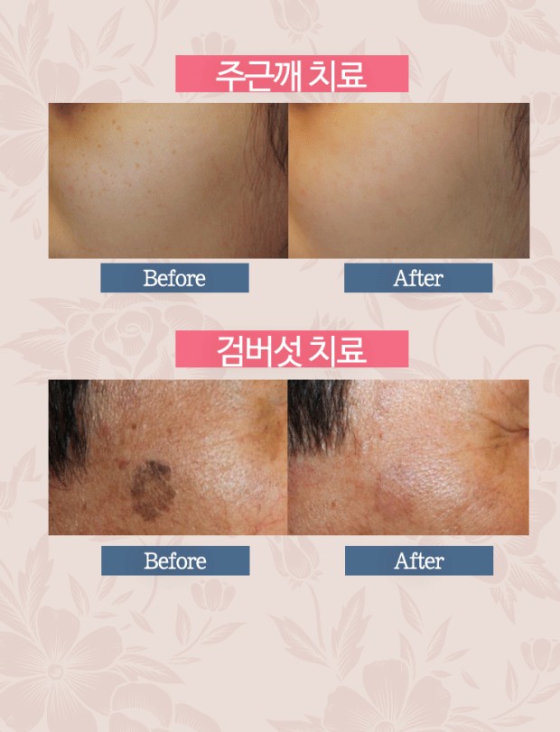 IPL 시술전후