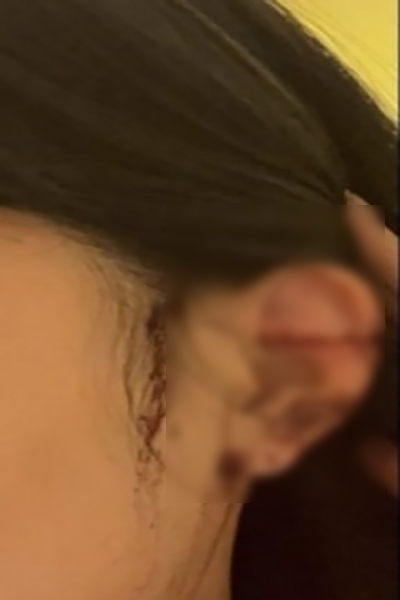 강남 클럽 귀 절단 사건