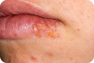 입술 수포의 증상