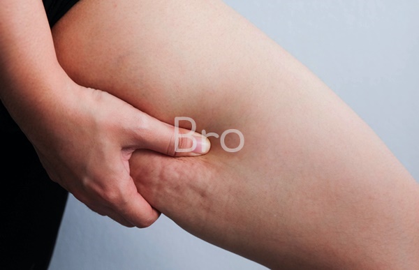 허벅지 셀룰라이트를 잡은 사진 2