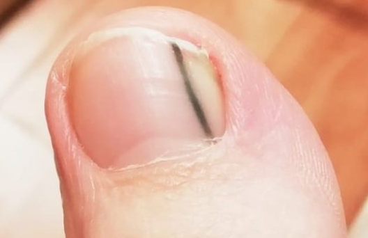 발톱에-생기는-갈색-줄