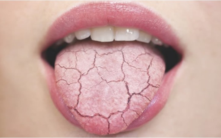 혀끝이-갈라지는-증상
