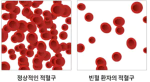 빈혈-사진4