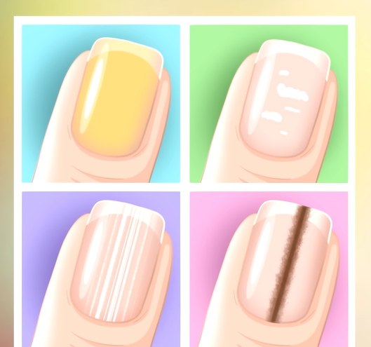 손톱에 세로줄이 생기는 이유