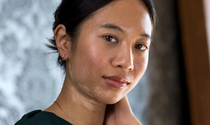 백반증 치료방법