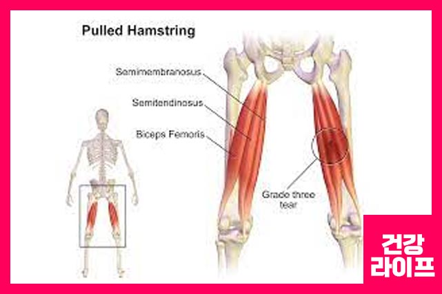 허벅지 통증 원인은 근육 부상, 염좌, 긴장