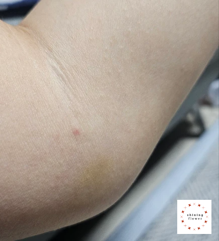 골프엘보-주사 및 물리치료 후 왼팔 사진