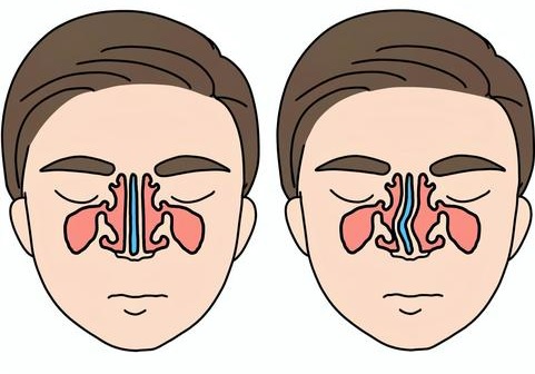 비중격만곡증